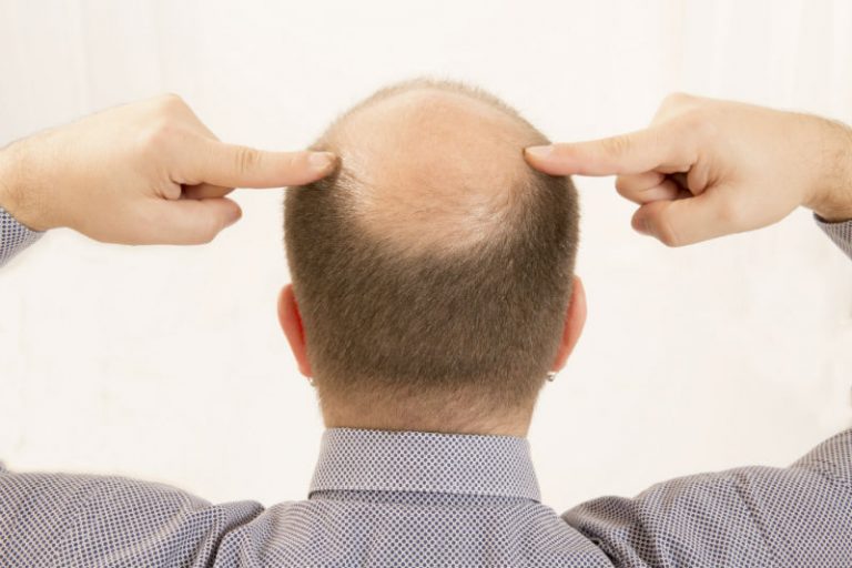 What You Should Know About Getting an FUE Hair Transplant in NYC